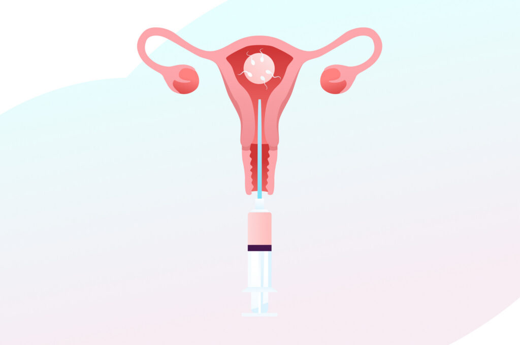 Illustration eines Embryotransfers in die Gebärmutter.